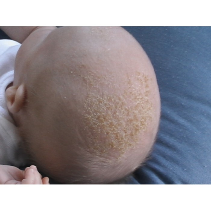 Silent Junction Lice Comb Nit Flea Cradle Cap Remover For Children